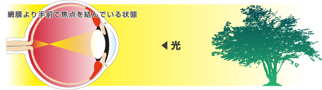 網膜より手前で焦点を結んでいる状態
