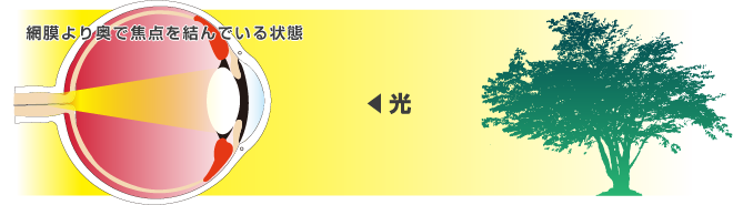 網膜より奥で焦点を結んでいる状態